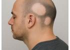 End Hair Loss with Alopecia Herbal Treatment in Noida
