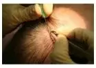 Advanced FUE Hair Transplant in Mumbai | Hair And Shape Clinic