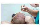 Hair Transplant Surgery in Mumbai With Natural Results