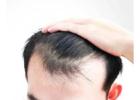 Best FUE Hair Transplant in Gurgaon At SB Trichology
