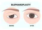 Affordable Blepharoplasty Surgery in Mumbai | Harleys Cosmetic Clinic