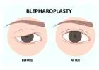 Affordable Blepharoplasty Surgery in Mumbai | Harleys Cosmetic Clinic