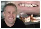 Why Are All On 4 Dental Implants Melbourne a Popular Choice?