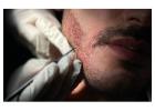 Get Natural Beard Transplant in Gurgaon | SB Trichology