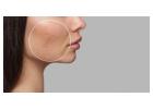 Transform Your Skin with Acne Scar Solutions in Vasant Kunj