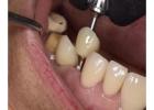 Get Your Perfect Smile by Treating from Dentist in Tijuana
