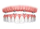 Find top-notch surgeons and dental equipment for Wisdom teeth removal Tijuana